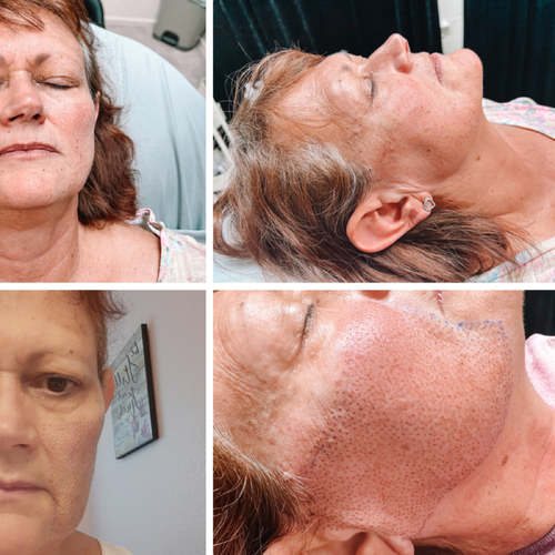 Jaw/Cheek Lift