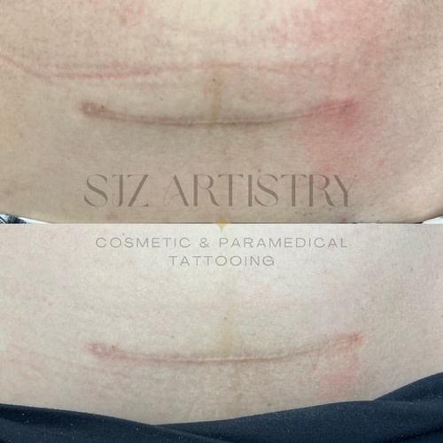 1st session Inkless Scar Revision. 