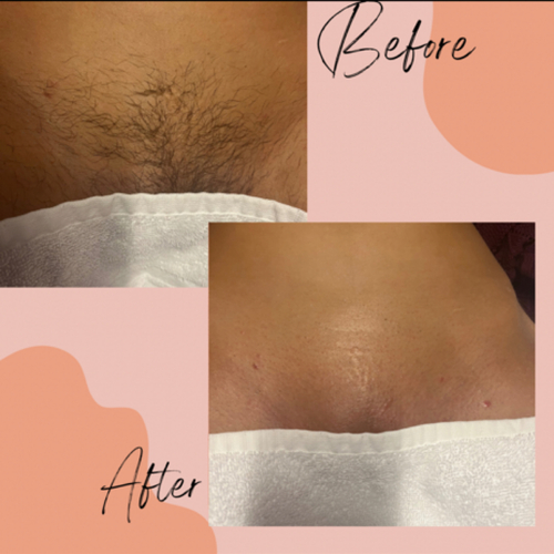 Brazilian wax 