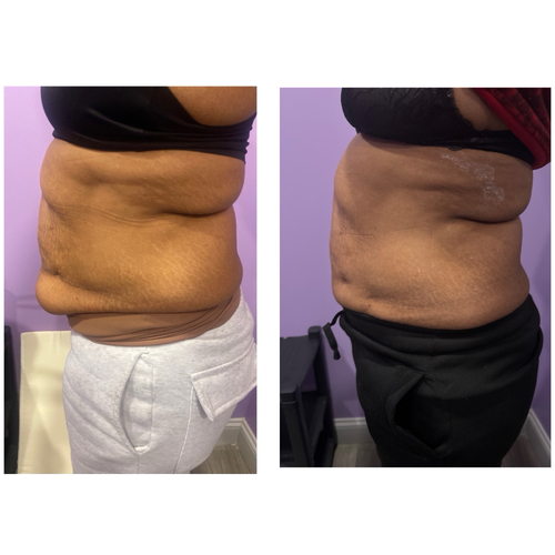 10 Lipo with cavitaton and skin tighting treatments 