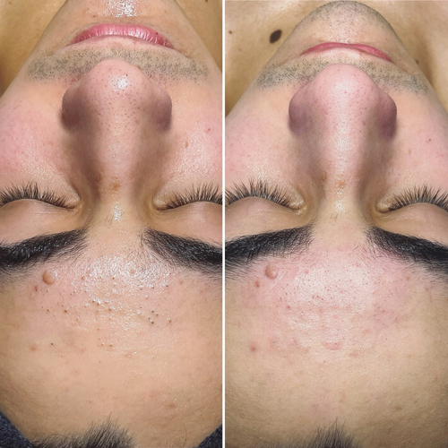 Blackhead Removal