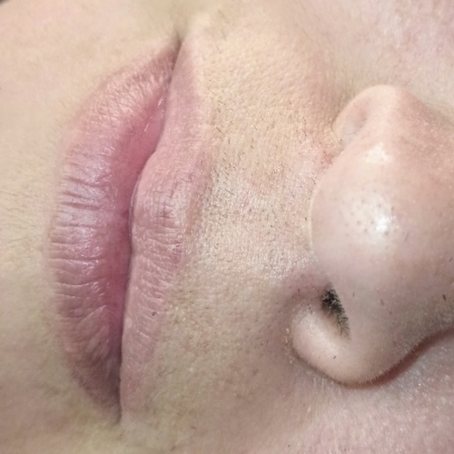 Upper lip 