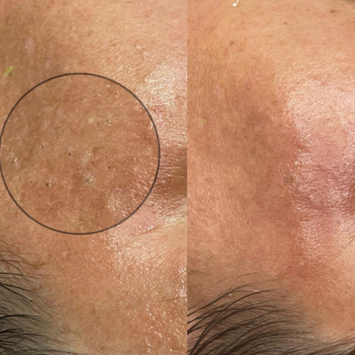 Deep Blackhead Extractions