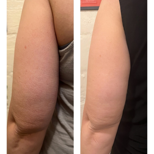 4 sessions of Cavitation on the Arm