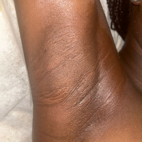 Under Arm: After 