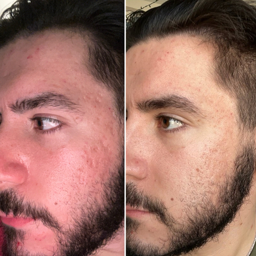 Relief from Acne Pitting thanks to a HydraFacial!