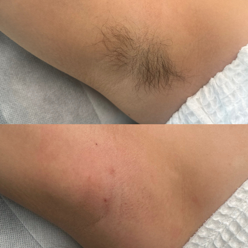 Underarm wax flawless and smooth!