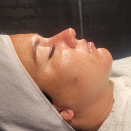 Post Enzyme facial