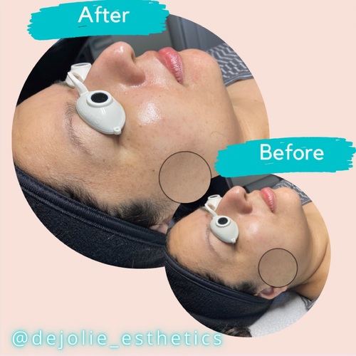 Post dermaplane: glowing hydrated skin with improved texture.