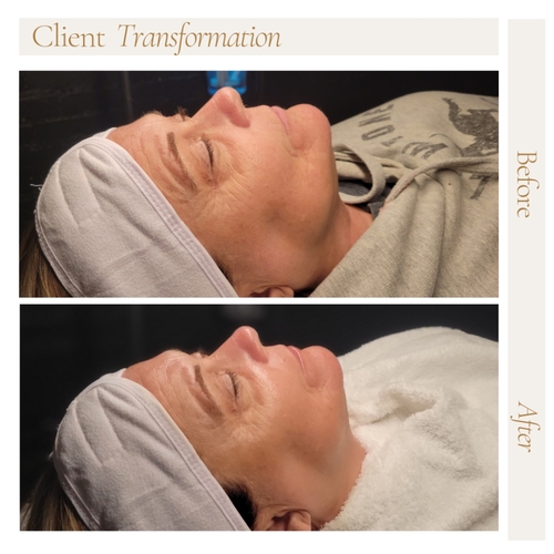 Before and after firming peptide facial 