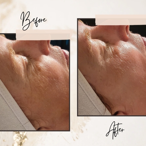 Firming peptide facial results. 