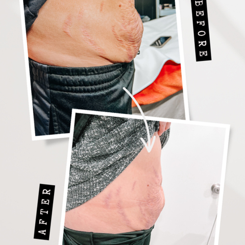 Plasma Fibroblast- Tummy Lift
1 session