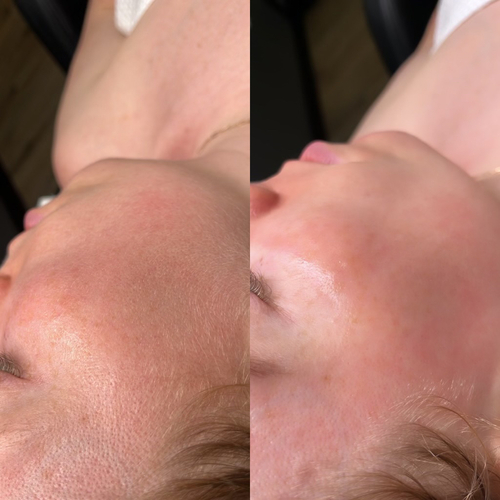Before & After — Dermaplane Treatment