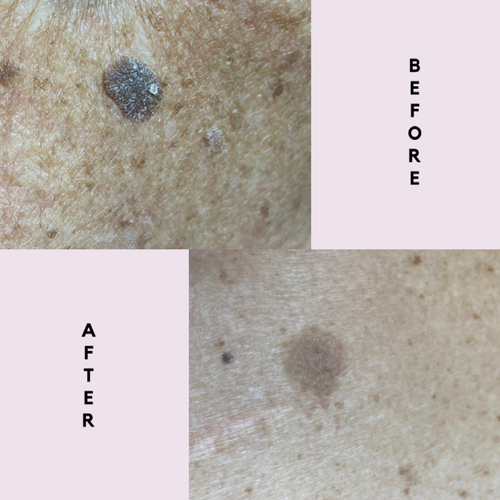 Keratosis treatment is quick and easy with the Skin Classic.