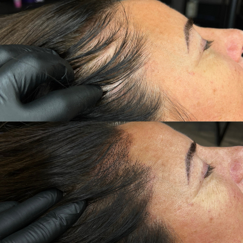 First Session - Scalp Micropigmentation for density