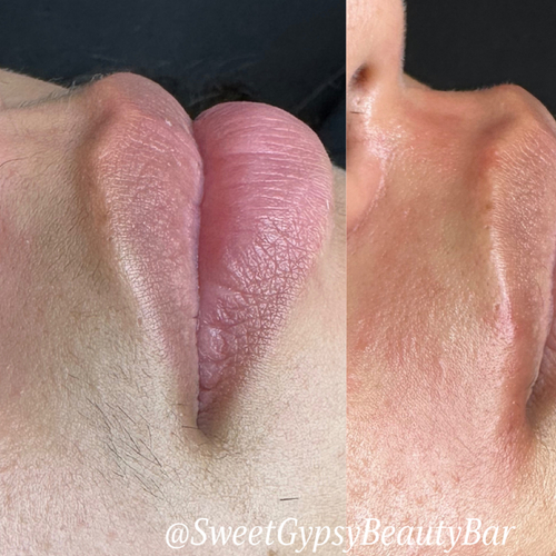 Upper lip threading