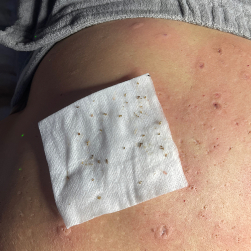 Back facial, deep cleaning, extractions 