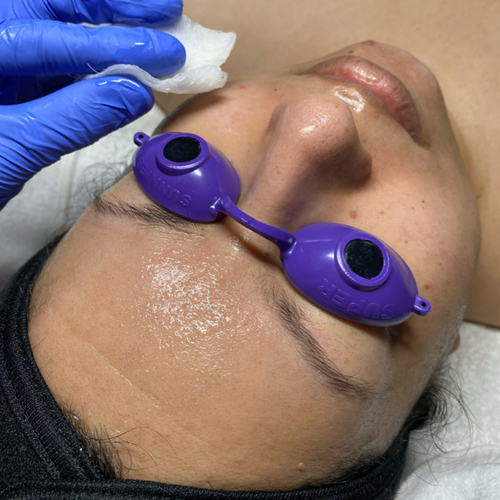 Chemical peel application on prepped skin. The client has been on appropriate home care to accommodate a peel as her next step.