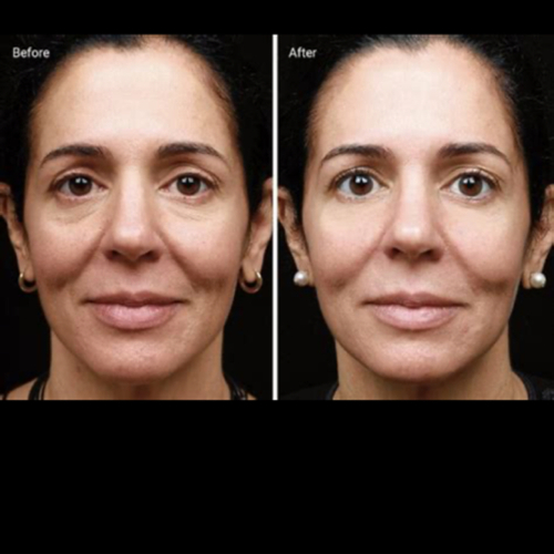 RF skin Tightening 