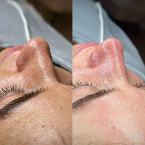 Facial oxygen Rx 