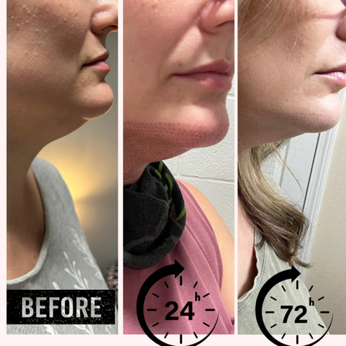 Neck/Under Chin Tightening 
