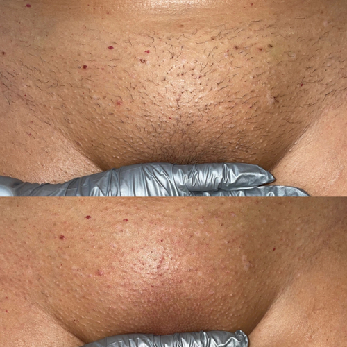 Before and after Brazilian wax (4 weeks in between) 