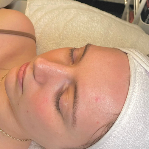 Before Gold Signature Facial