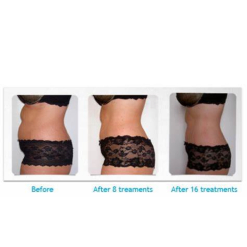 Lipo , Cavitation and RF Skin Tightening 
