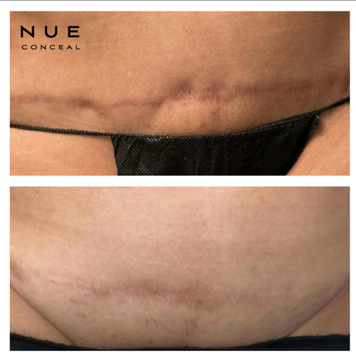 Abdominal Scar Repigmentation & Lightening