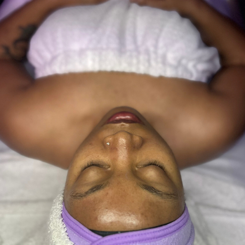 After Hydrofacial