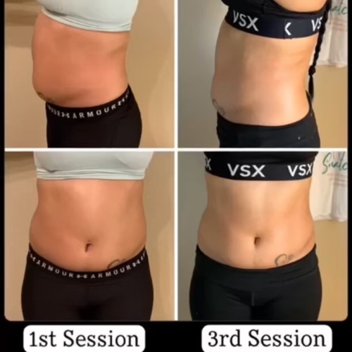 Body Contouring. 
Treatment consists of 20 minutes of Ultrasound Cavitation, 10 minutes of Radio Frequency, 20 minutes Laser Lipo and massage.