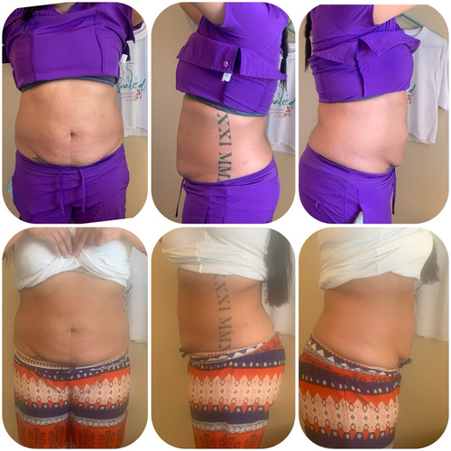 Body Contouring