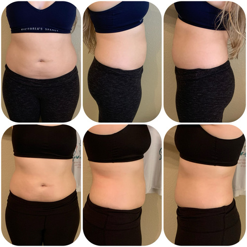 Body Contouring
