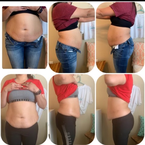 Body Contouring