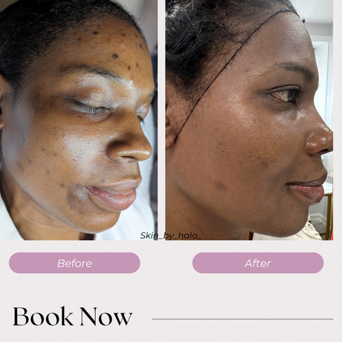 Biorepeel Treatment (Chemical Peel) 