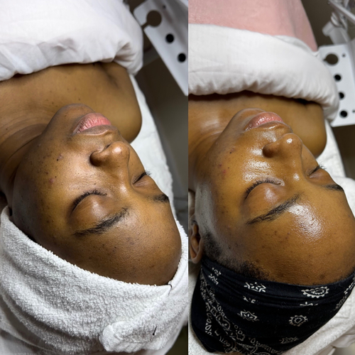 Oxygen Glass Facial