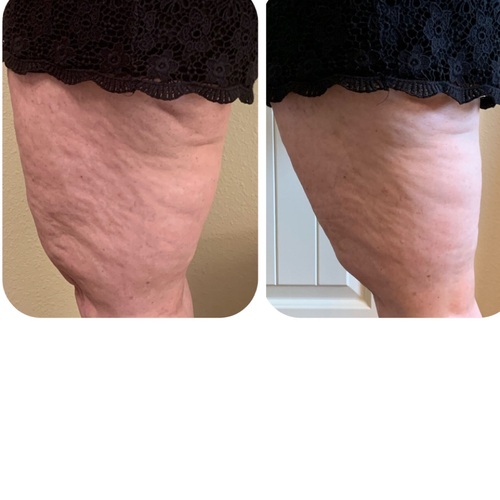 Cellulite leg treatment. Vacuum Therapy/Cavitation/Radio Frequency/. 6 Sessions in.