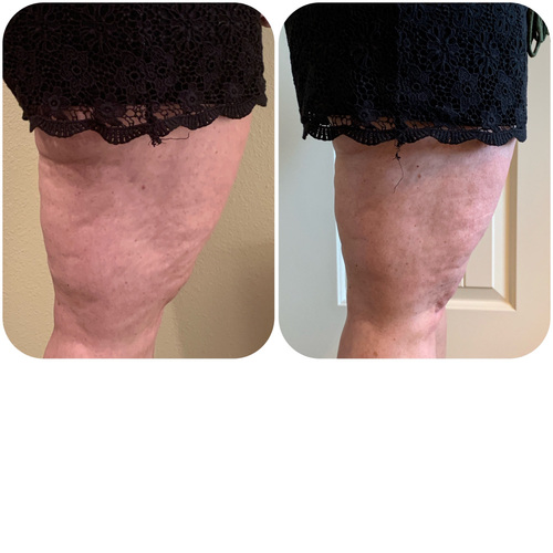 Working on the Clients circumference of the thighs. Including Wood Therapy.