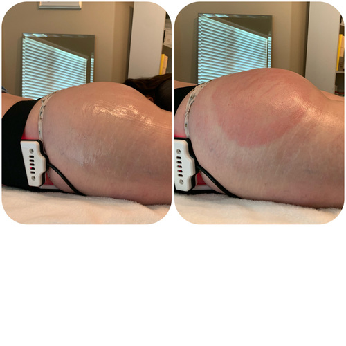 Plumping the Booty.