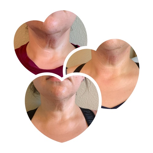 Chin Laser Lipo.