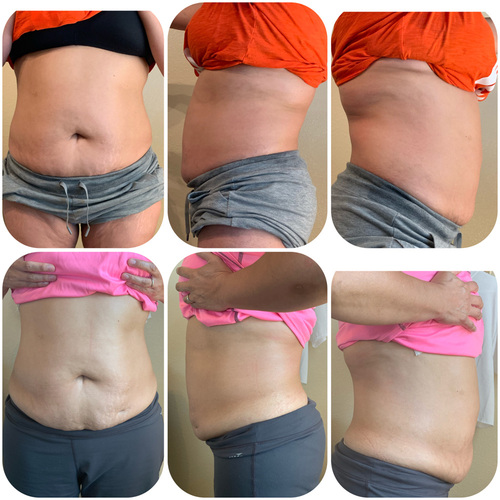 Body Contouring. Smoothing down the stretch marks.