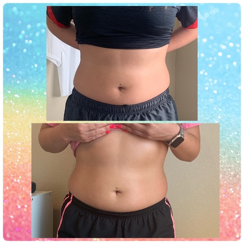 Body Contouring along with Wood Therapy. Smoothing and toning the tummy.