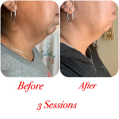 Chin Laser Lipo.