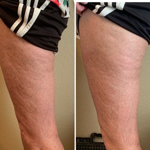 Smoothing out the legs. Promoting Collagen.