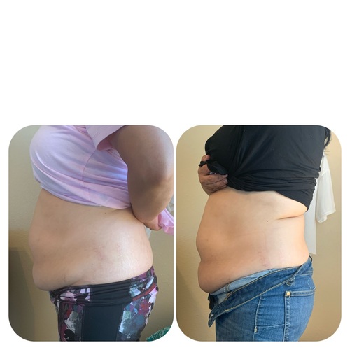 Losing inches and getting rid of the bloat with Body Contouring.