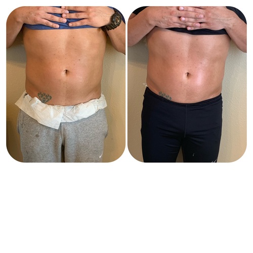 Defining abs with Wood Therapy. 