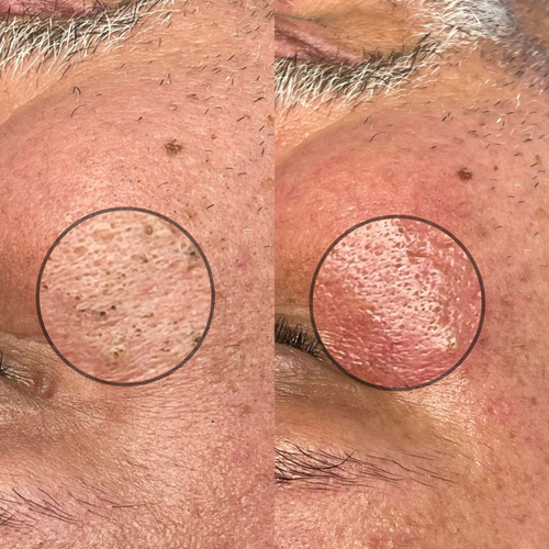Deep Detox Acne Facial with Blackhead removal 