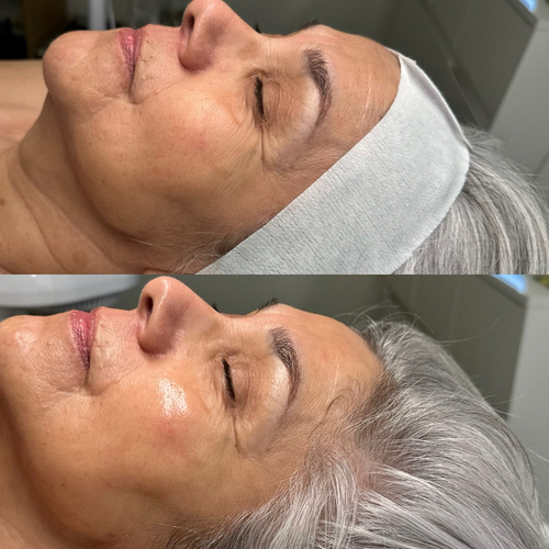 Dermaplane deluxe glow