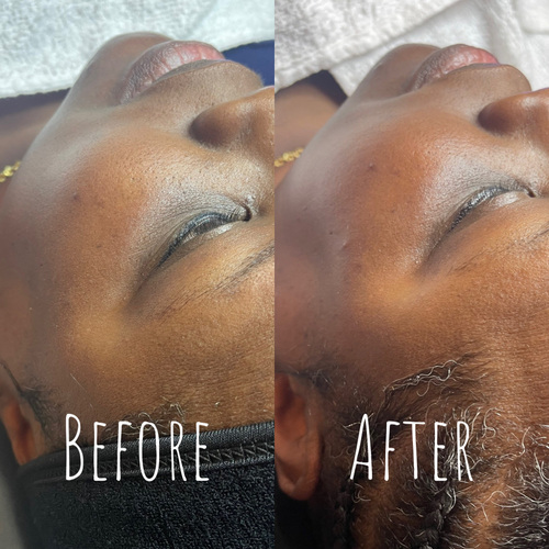 Dermaplane Facial 