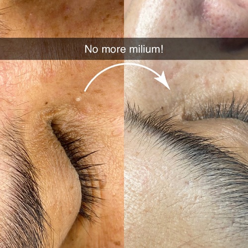 Skin Classic safely and effectively removes minor skin irregularities with no downtime.